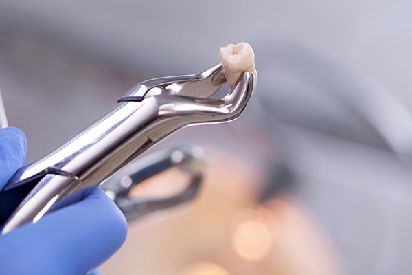 Tooth Extraction in Atlanta