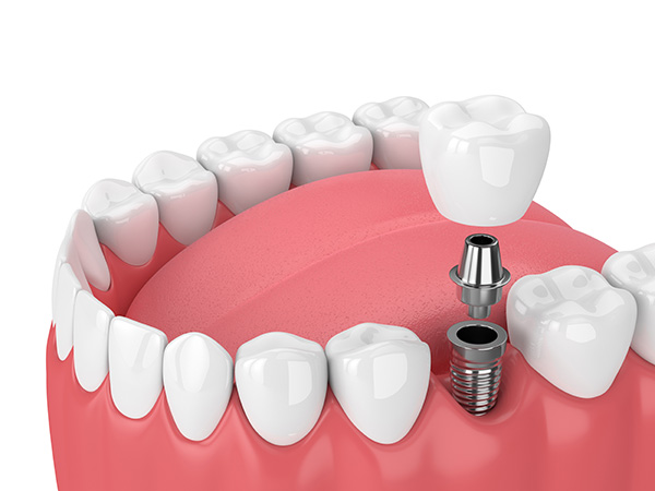 Dental Implant Surgery in Atlanta