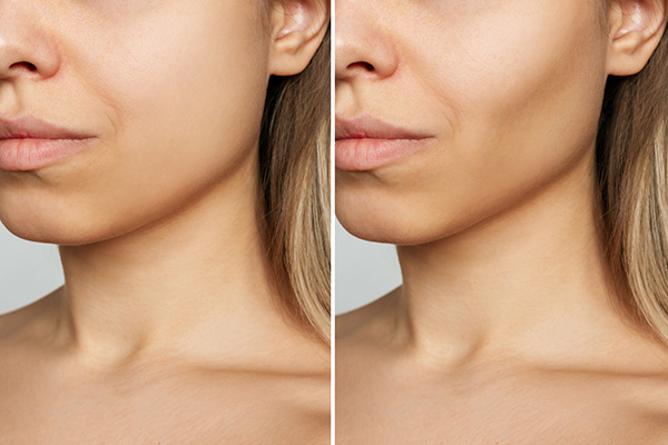 Buccal Fat Reduction Atlanta, GA  Radiance Surgery and Aesthetic