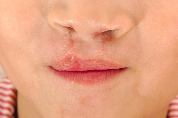cleft lip and palate corrective